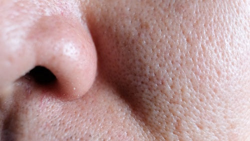 All You Need To Know About Large Pores and Treatment