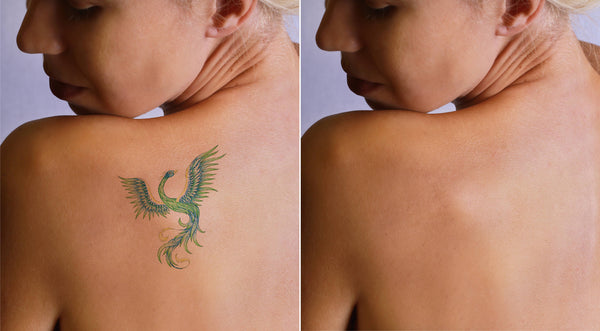 Is It Possible To Remove Tattoos Completely And Painlessly?