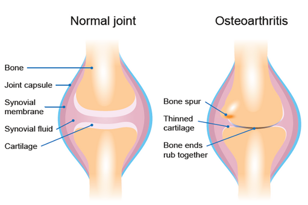 Lidocaine Cream for Instant Pain Relief from Osteoarthritis: PART 1
